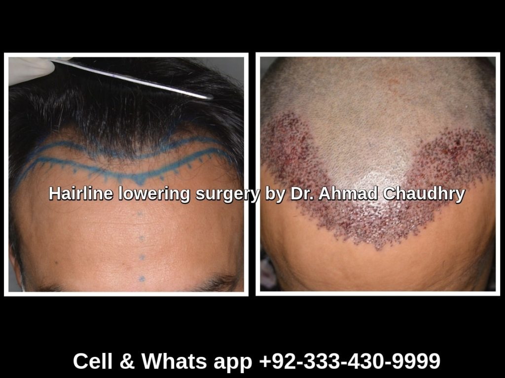 Hairline lowering surgery male Lahore Pakistan