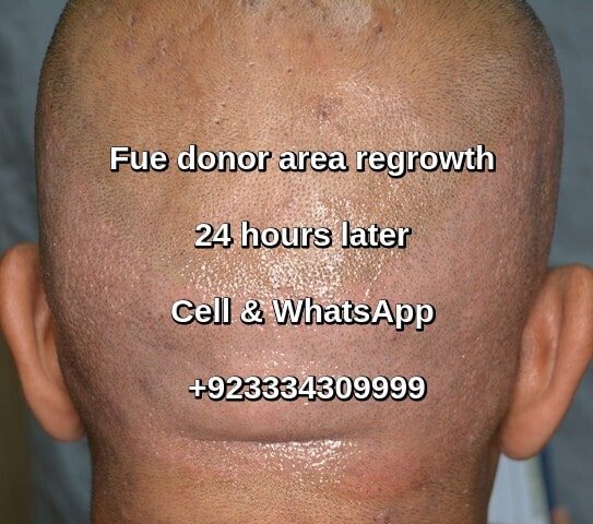 After Fue hair transplant hair grow back