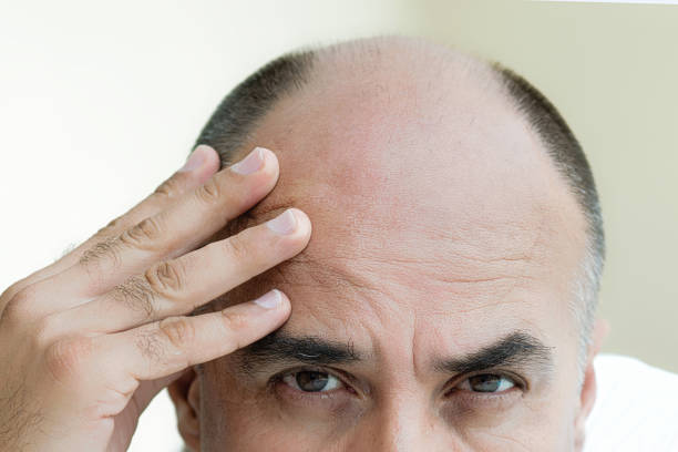 Baldness treatment Italy