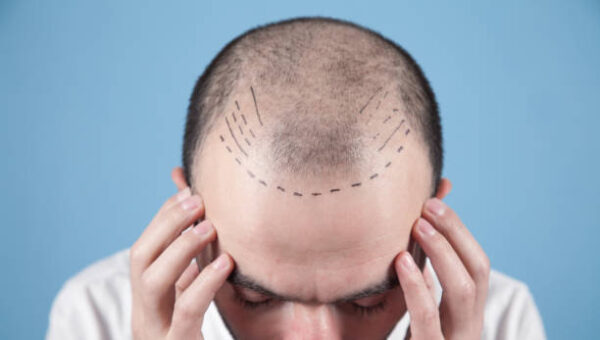 Read more about the article Fue hair transplant Perth