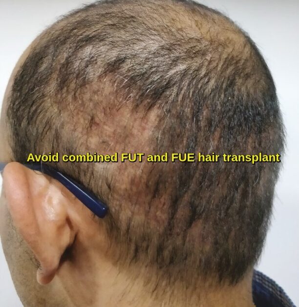 Hybrid hair transplant