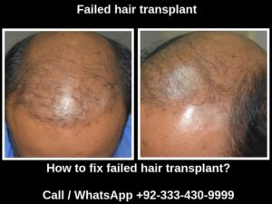 Failed hair transplant fixing Pakistan