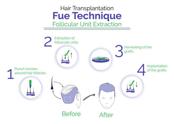 Fue hair transplant London stages