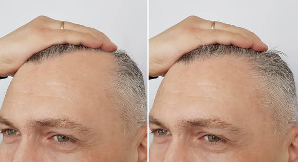 Baldness treatment through hair restoration