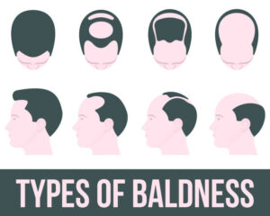 Baldness types