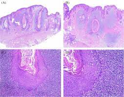 Histopathology lichen planus follicularis timidus