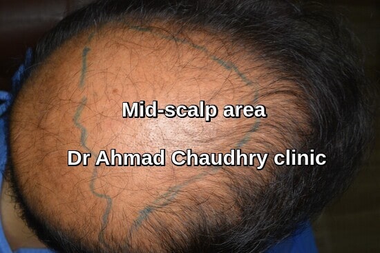 Mid scalp area marking 