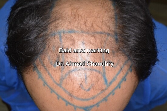 Blue marking before baldness surgical treatment