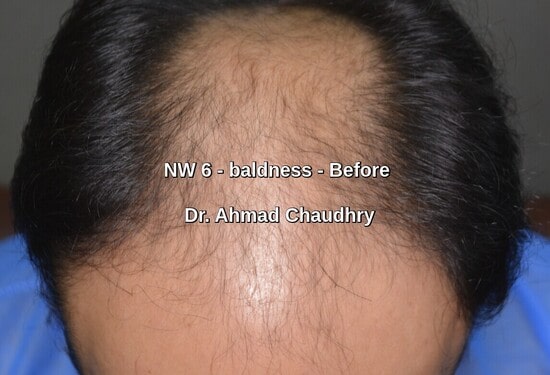 Full baldness Sialkot patient