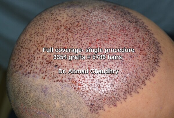 Hair transplant Sialkot patient full baldness treatment
