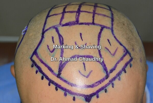 Marking -shaving hair transplant area