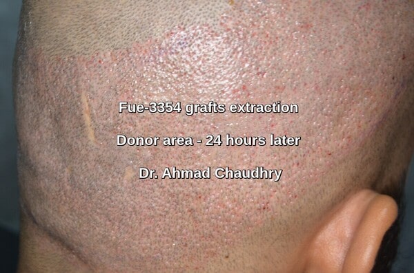 Sialkot patient 3354 grafts donor area