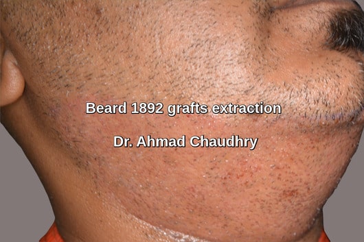 Beard donor area grafts 24 hours later