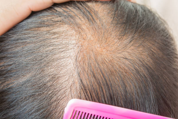 poly cystic ovarian syndrome hair thinning