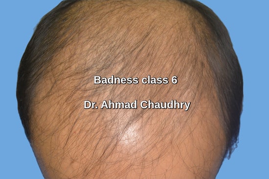 Baldness patient Islamabad
