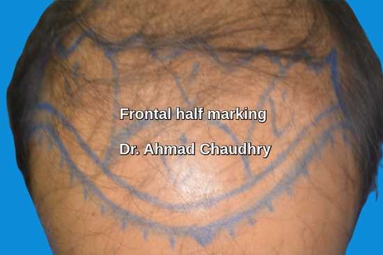Baldness treatment marking Pakistan