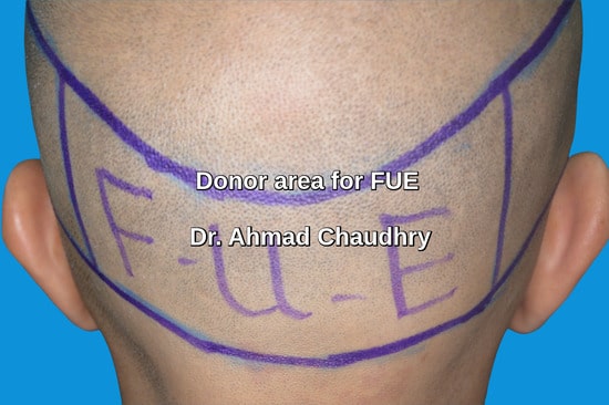 Fue hair transplant donor area 