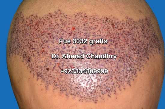 Hair transplant Islamabad Pakistan