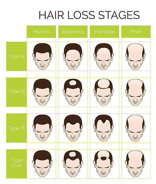 Male pattern baldness treatment Lahore Pakistan