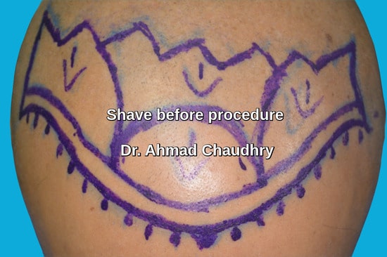 Shave before transplant patient