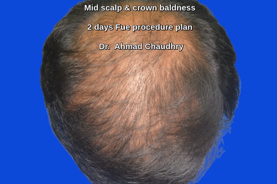Baldness mid scalp-crown area