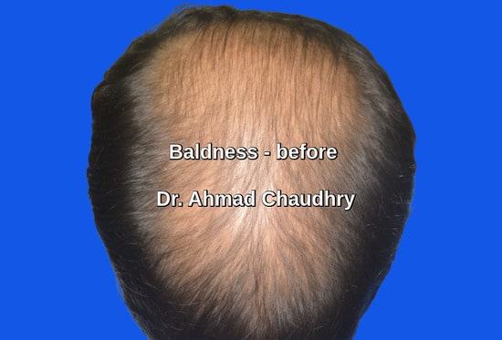 Hair loss patient Canada
