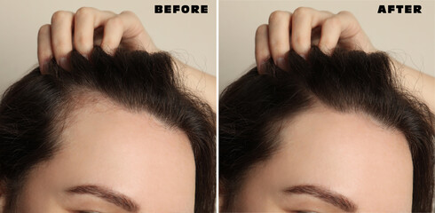 Female pattern hair loss treatment Pakistan