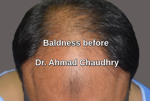 Permanent baldness solution Lahore Pakistan