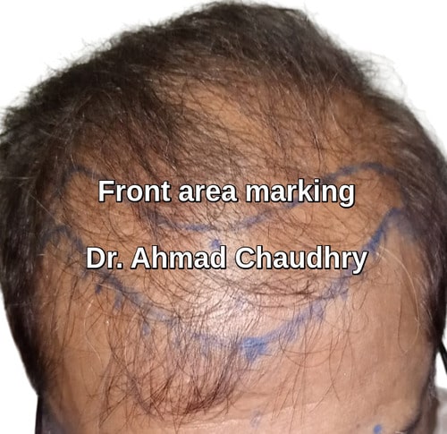 Hairline replacement Pakistan