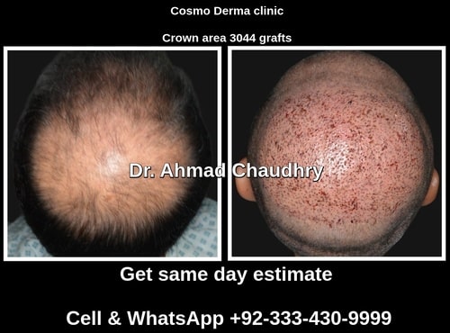 3044 grafts hair transplant cost Canada