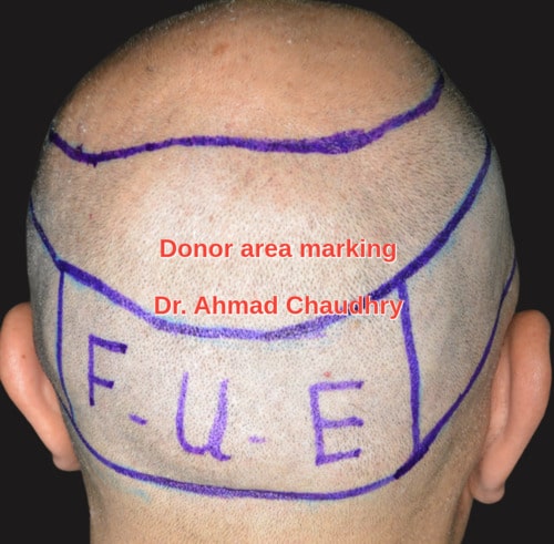 Fue donor area marking step two
