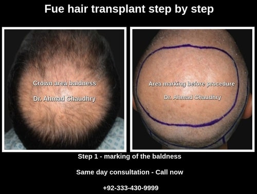 Fue hair transplant step by step