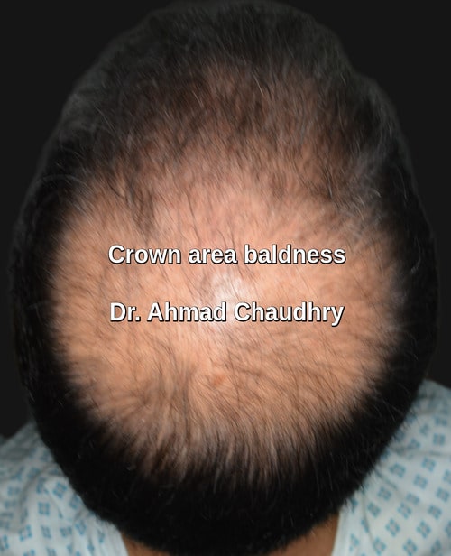 crown baldness before