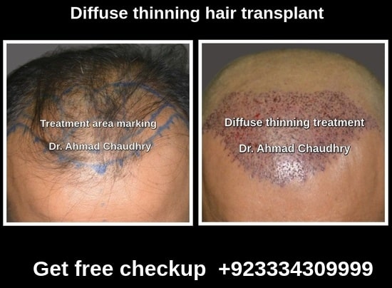 Diffuse hair loss treatment Pakistan