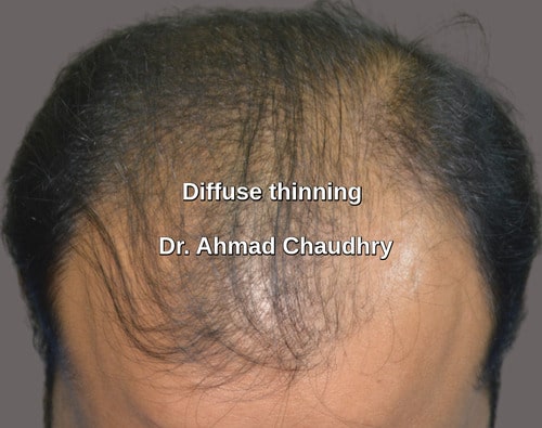 Diffuse thinning hair transplant Pakistan