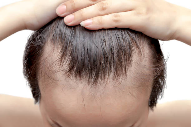 Male hair loss cause and treatment