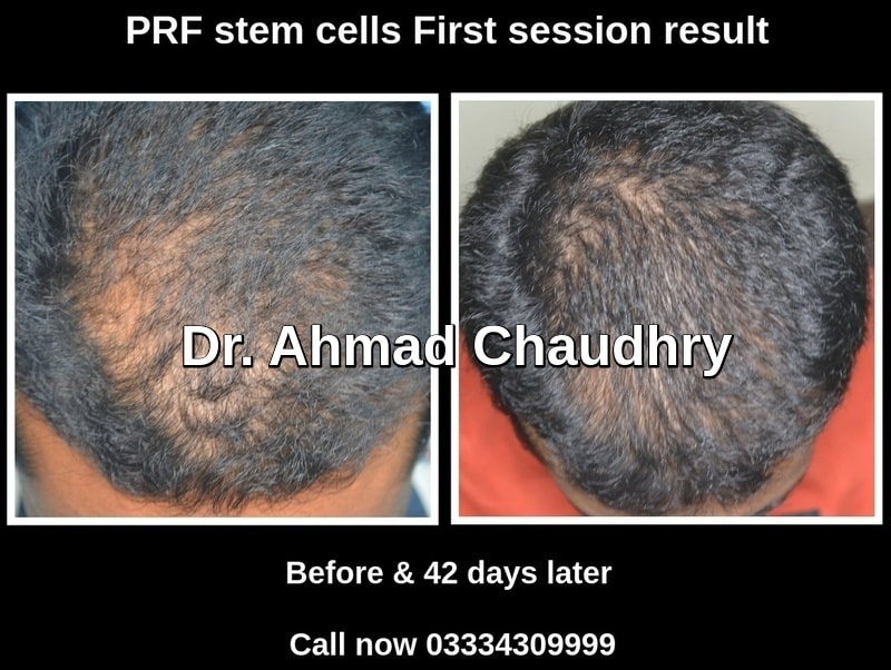 Medical hair restoration Lahore