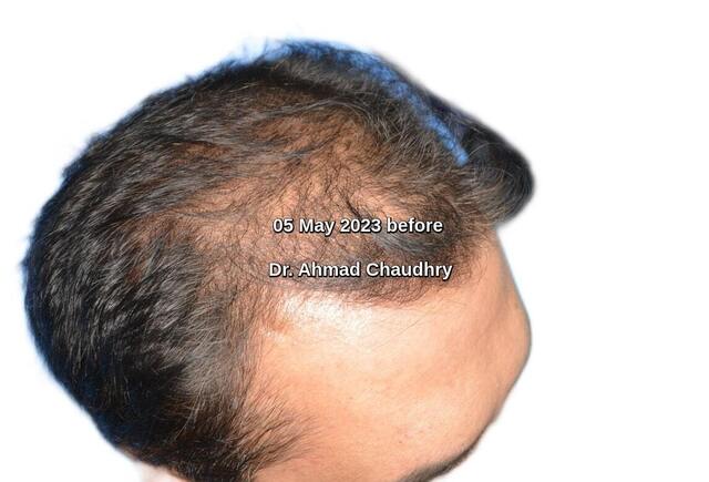 Before hair loss treatment