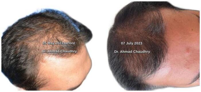 Stem cells exosomes hair regrowth treatment Pakistan