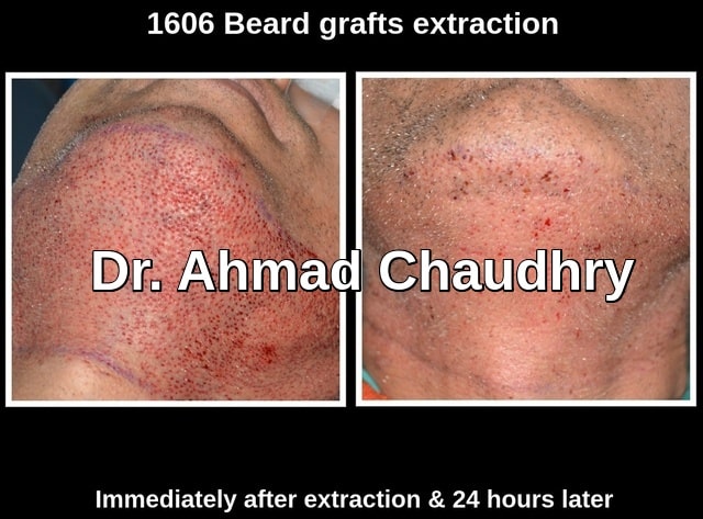 1606 beard grafts after extraction