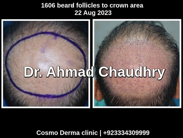 1606 grafts crown area intraoperative and one day later
