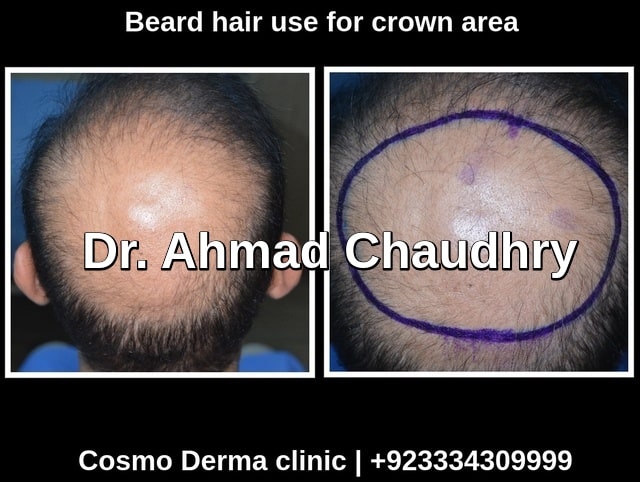Beard hair for crown area use