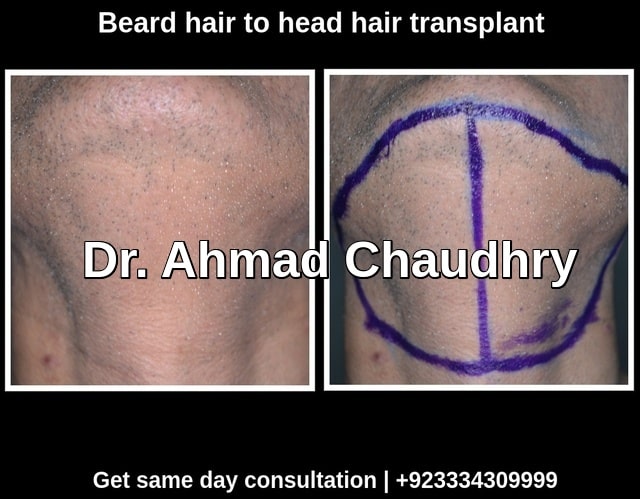 Beard hair to head hair transplant Pakistan